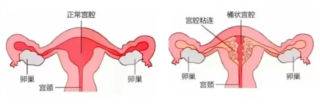 宫腔粘连.png